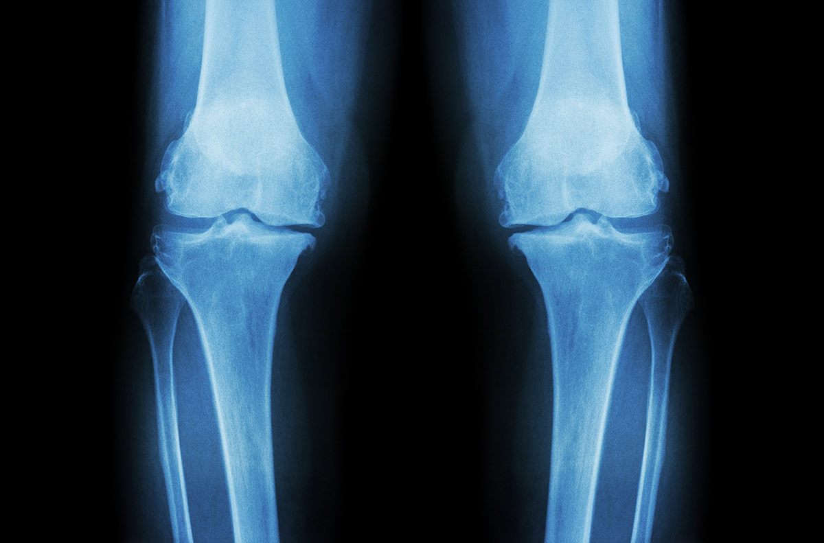 Picture of Knee Cartilage X-Ray